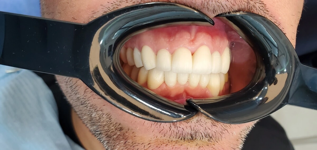 premium_dental_care_after1_pic