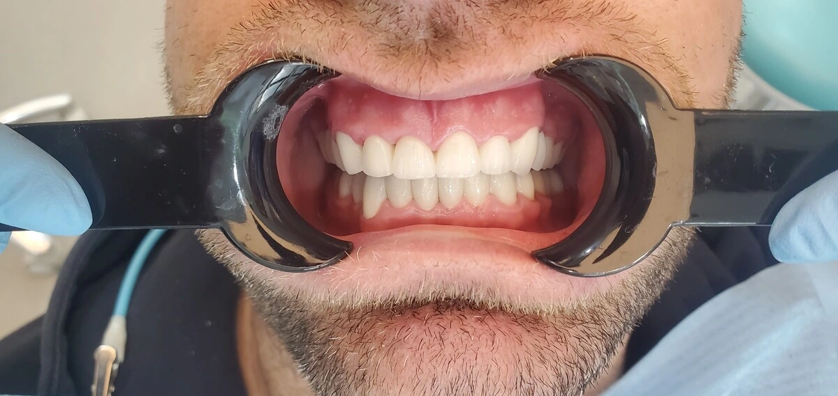 premium_dental_care_after_pic
