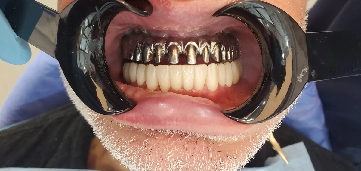 premium_dental_care_before1_pic