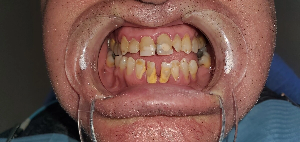 premium_dental_care_before_pic